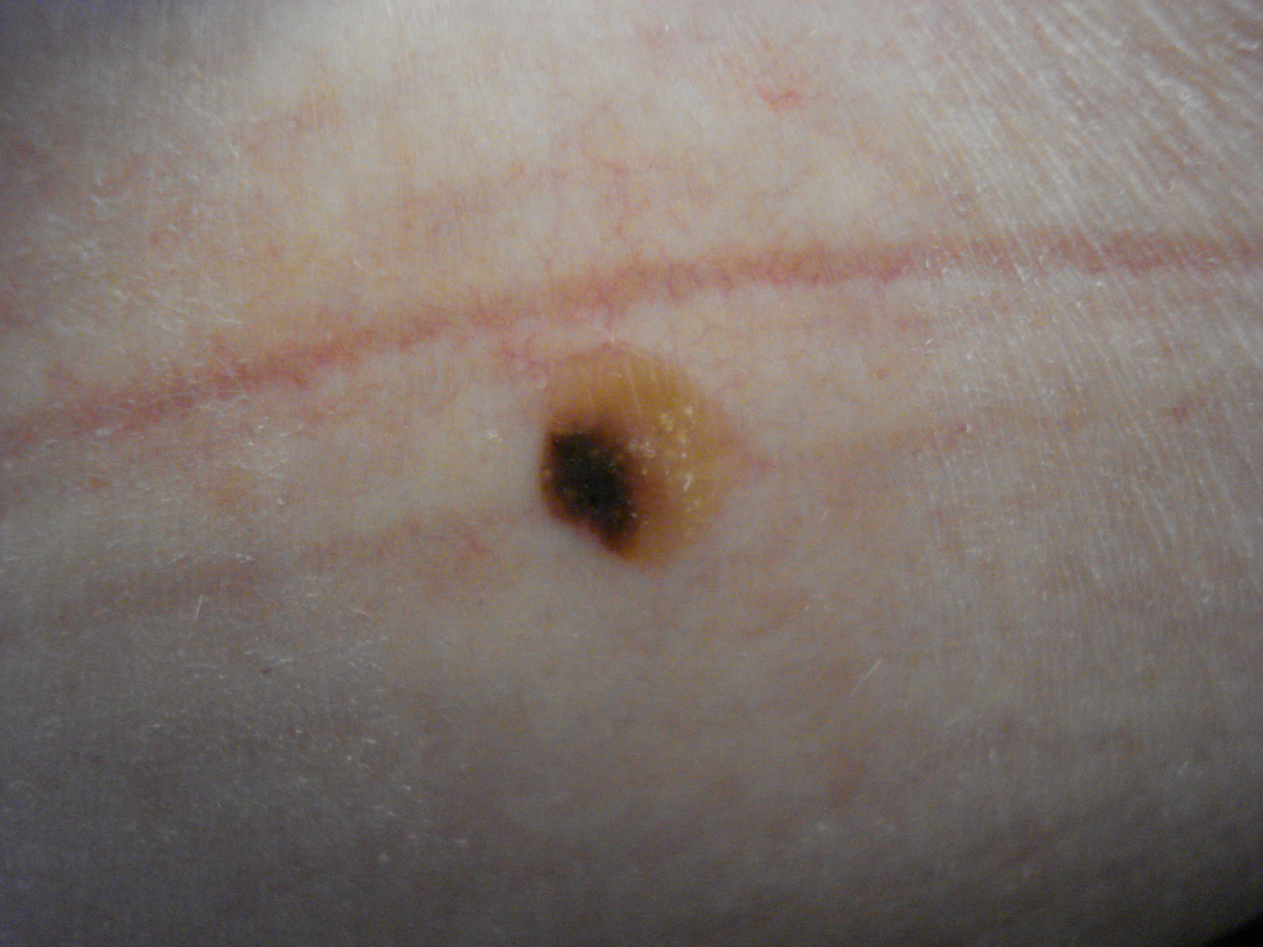 pigmented skin lesion #11