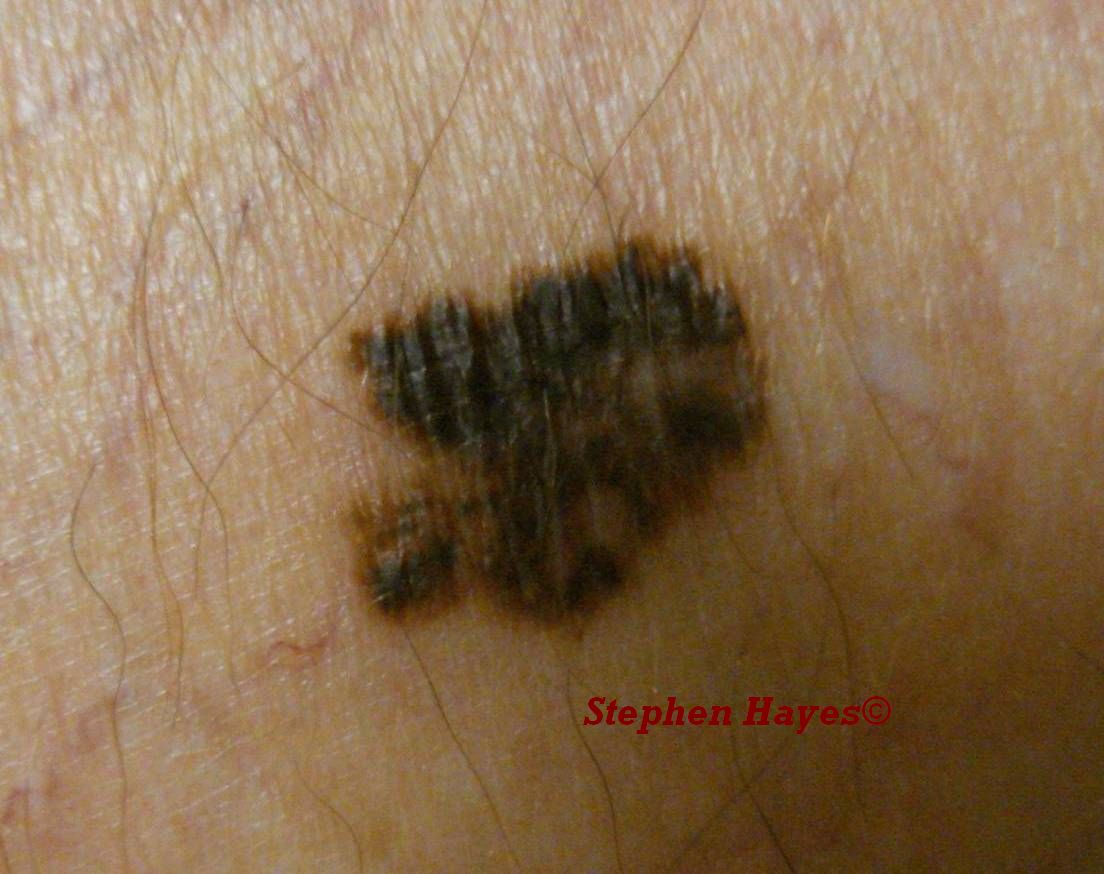 pigmented skin lesion