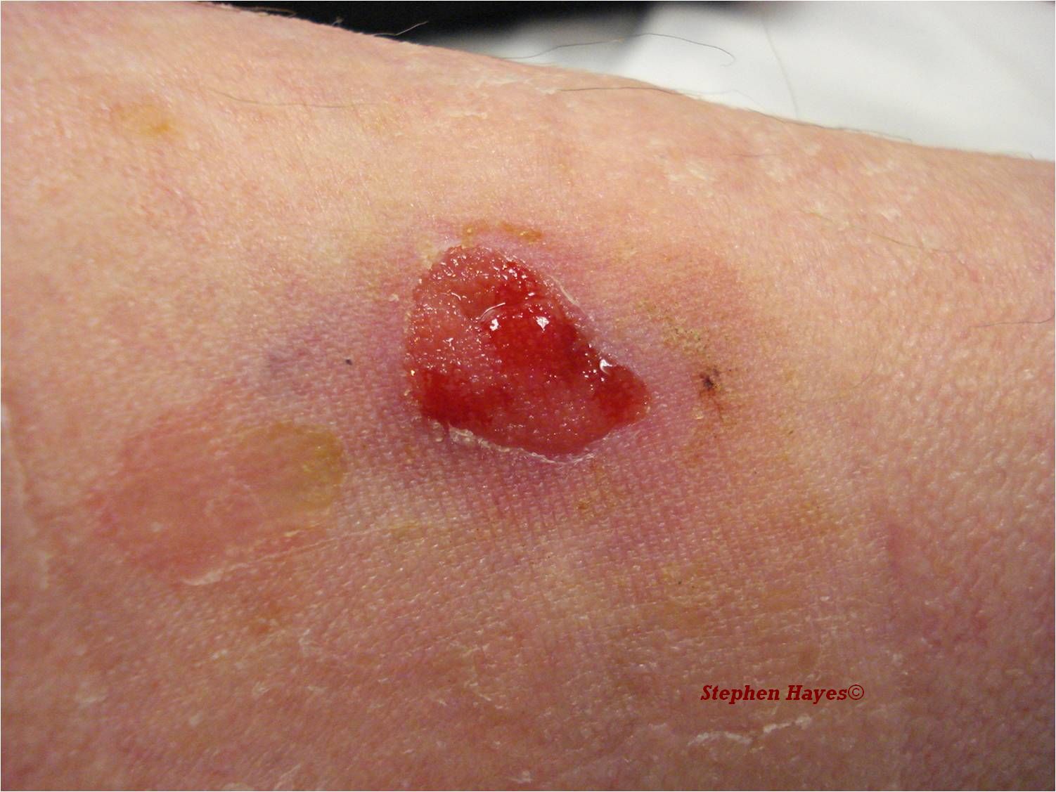 basal cell cancers pictures #10
