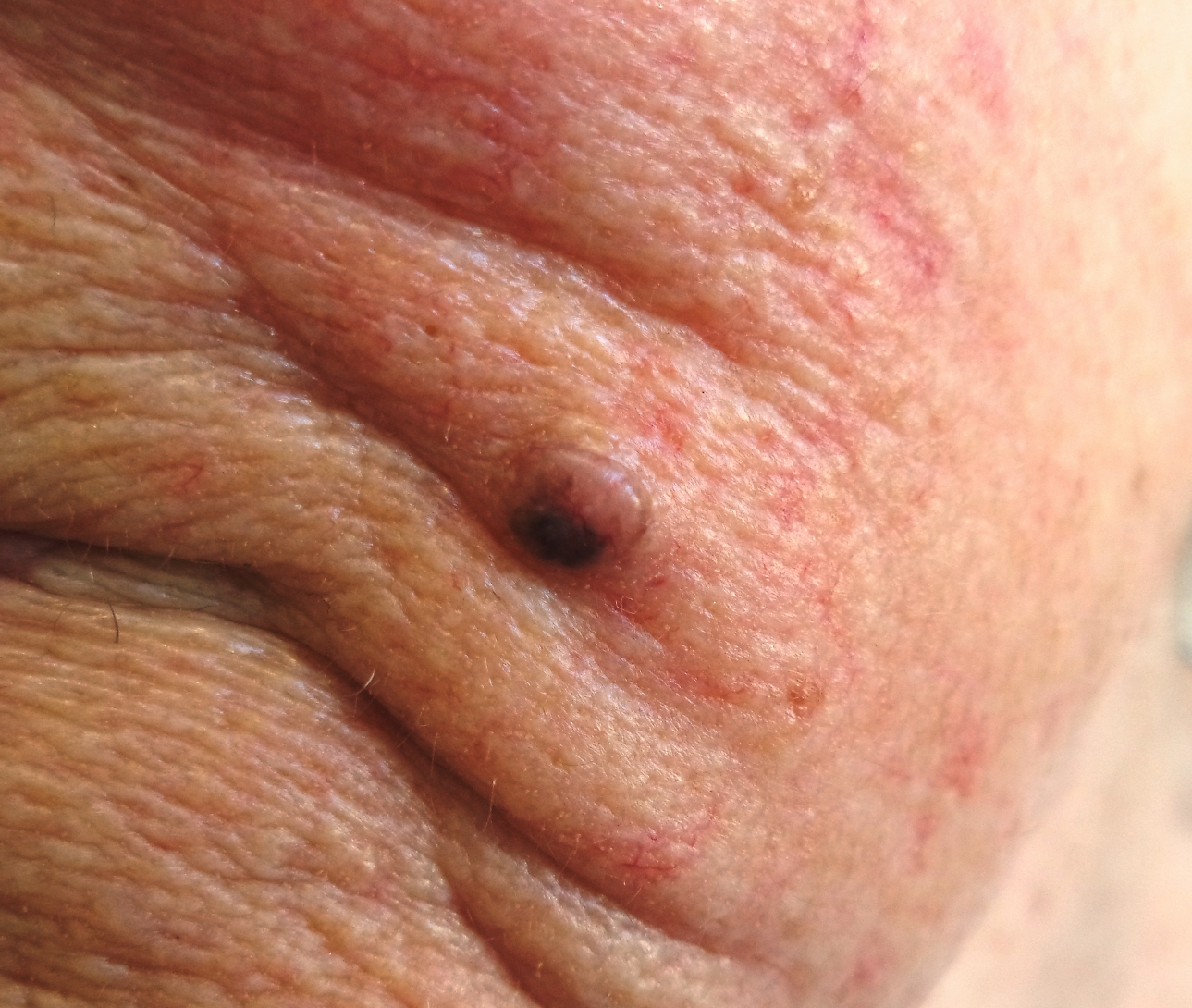 Dermoscopy of pigmented skin lesions. - The Doctor's Doctor