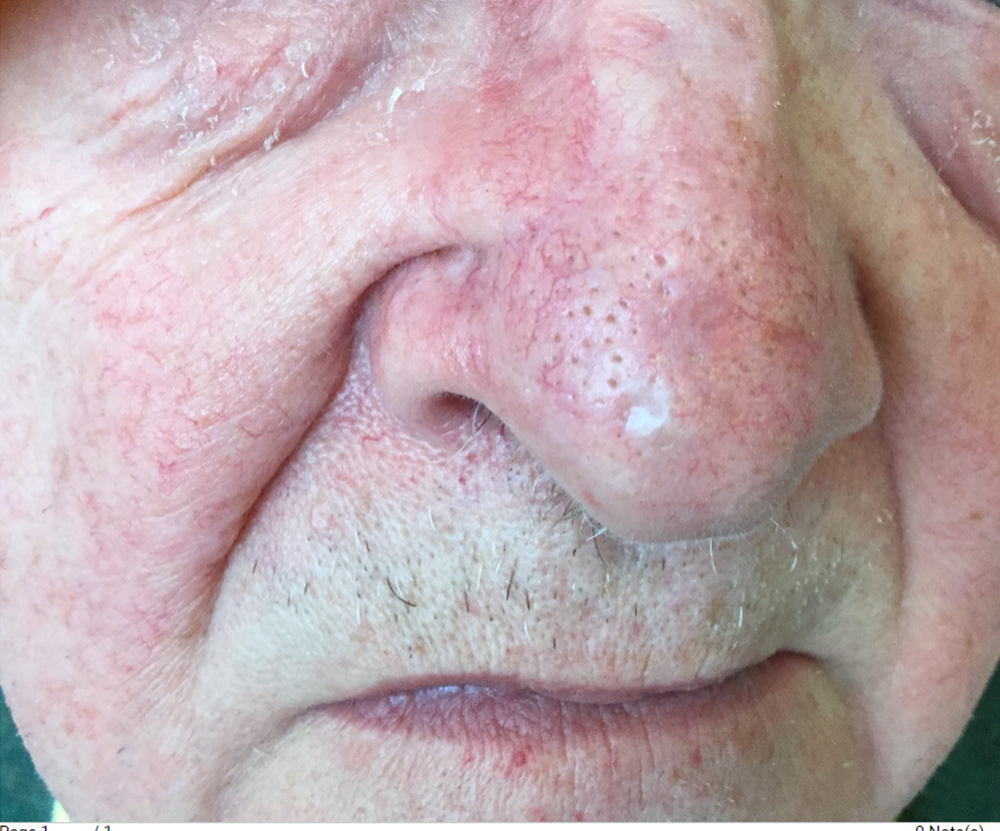 Basal Cell Cancer On Nose Dermoscopy